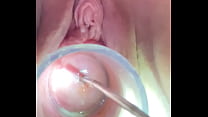 Hegar sound probing deep in cervix